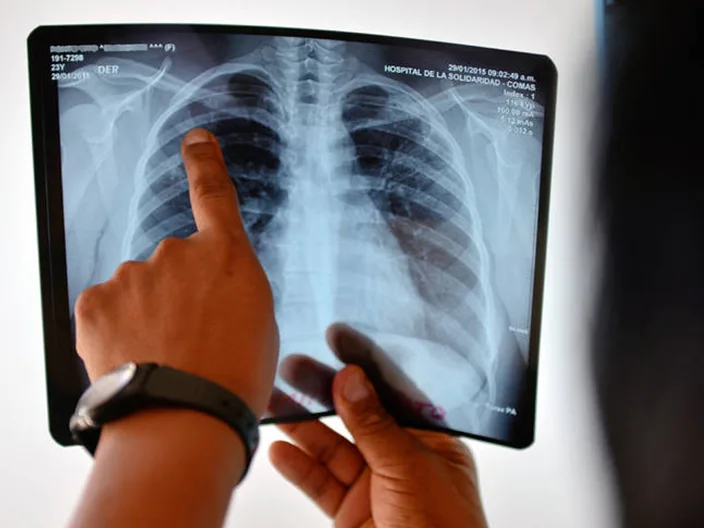 Tuberculosis: otro flagelo que viene acompañada de la mano de la pobreza