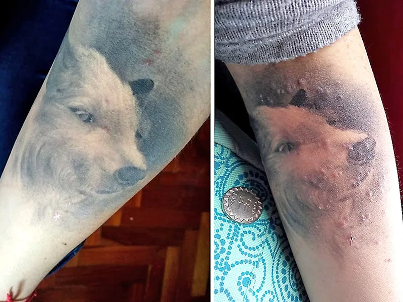 Detectan 67 casos de infecciones en la piel por hacerse tatuajes