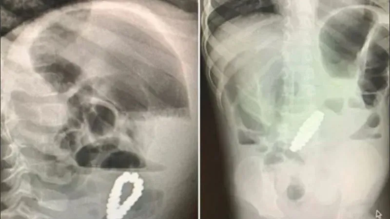Increíble: le dolía la panza, lo llevaron al médico y le encontraron un raro objeto adentro
