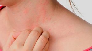 Urticaria crónica: más allá de la picazón, un impacto profundo en la calidad de vida