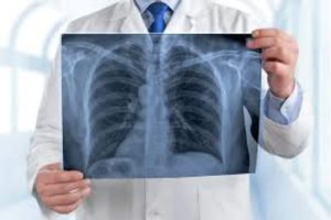 Día Mundial contra la Neumonía: prevenir para salvar vidas