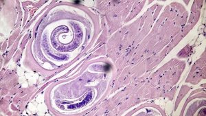 Triquinosis: qué es, cuáles son sus síntomas y cómo se transmite