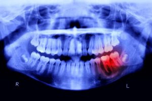 Científicos japoneses desarrollan el primer fármaco para regenerar dientes perdidos