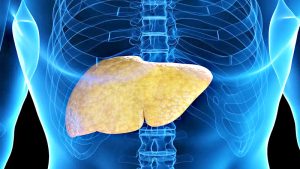 Qué es el hígado graso y cómo puede afectar tu salud