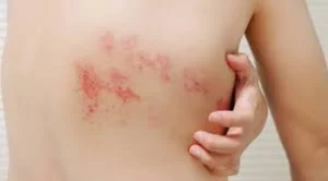 El herpes zóster afecta cada vez a más adultos mayores y genera preocupación médica por sus secuelas