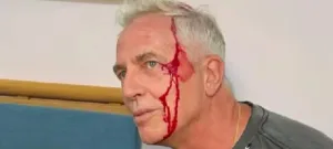 La impactante imagen de Marley luego de su accidente en medio de su viaje a Tailandia: “Quedé chorreando sangre”