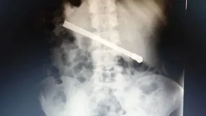 Radiografía del preso con la bombilla dentro de su cuerpo