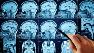 Imágenes de resonancia magnética cerebral