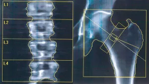 Cómo funciona la innovadora técnica que permitiría revertir el avance de la osteoporosis