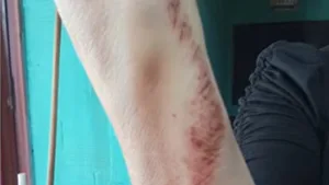 Puerto San Martín: se defendió de un ladrón y lo hizo huir tras empujarlo por el balcón