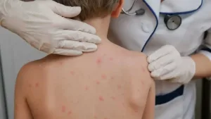 Santa Fe activó el protocolo por sarampión tras el paso por Rosario de una familia de Uruguay con casos confirmados