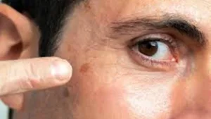 prevención del cáncer de piel