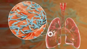 Día Mundial de la Tuberculosis: actualizaron las pautas para su abordaje en todo el país