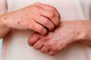 Alerta epidemiológica: confirman el primer caso de una variante más contagiosa y severa de la viruela símica