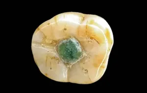¿El primer empaste dental?: los mayas arreglaron una muela con una piedra preciosa
