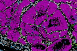 Hallan un gen que determina si las células de cáncer formarán metástasis o se quedarán dormidas