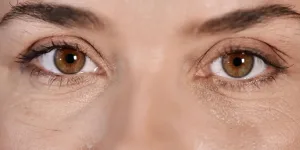 Párpados caídos y bolsas: cómo funciona la blefaroplastia con láser híbrido