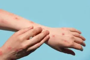 Confirmaron un nuevo caso de Mpox: ¿qué es y cómo se contagia?