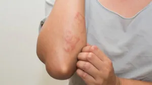 Dermatitis atópica: las dificultades para sostener la atención y el tratamiento